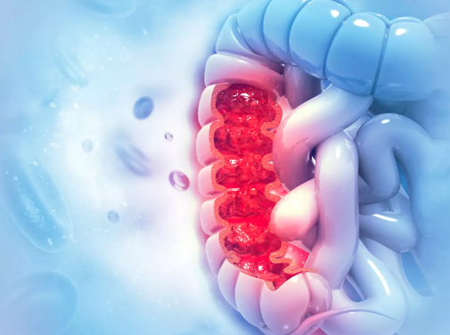 Colonoscopy Doctor in Bronxville, New Rochelle, Westchester County, White Plains, Yonkers, and the Surrounding Areas