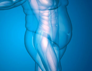 X-Ray of Belly Before Lap Band Surgery with a Weight Loss Doctor in Westchester County, NY